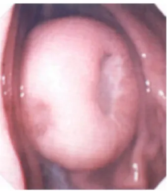 Fig. 5. Microscopic findings of gastritis cystica profunda and adenocarcinoma. The architecture of the mucosal surface is intact.