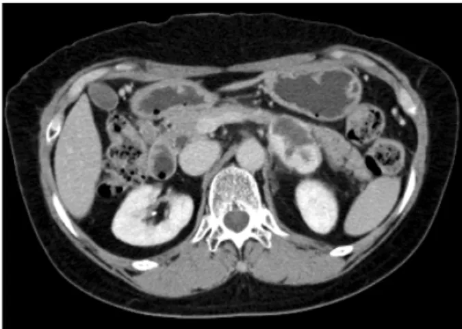 Fig.  1.  Abdominal  CT  showed  a  4.5×3.4  cm  sized  solid  mass  with  heterogenous  enhancement  between  pancreatic  tail  and  left  kidney.