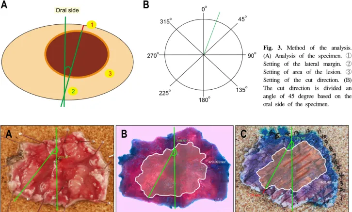 Fig.  4.  (A)  Gross  finding.  (B)  Stereoscopic  finding.  (C)  Pathologic  mapping.