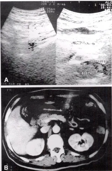 Fig. 1. Abdominal ultrasonography and CT scan finding. (A) The left panel of abdominal sonography is Doppler image that shows no blood flow at superior mesenteric artery