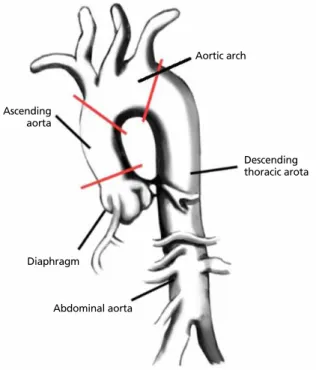 Table 1.  Normal thoracic aortic diameters[4]