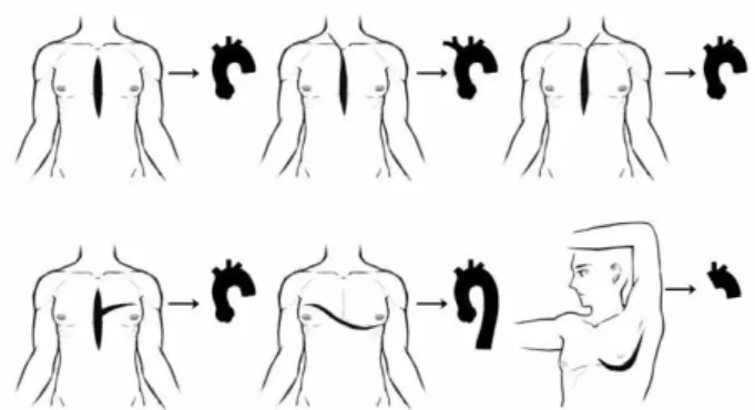 Figure 3.  Surgical approach based on the level of thoracic aortic aneurysm.