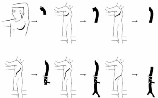 Figure 4.  Surgical approach based on the level of thoracoabdominal aortic  aneurysm.