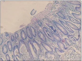 Fig.  2.  Sigmoidoscopic  finding.  There  were  diffusely  scattered  numerous  elevated  yellowish  plaques  with  edematous  and   hypere-mic  mucosa.