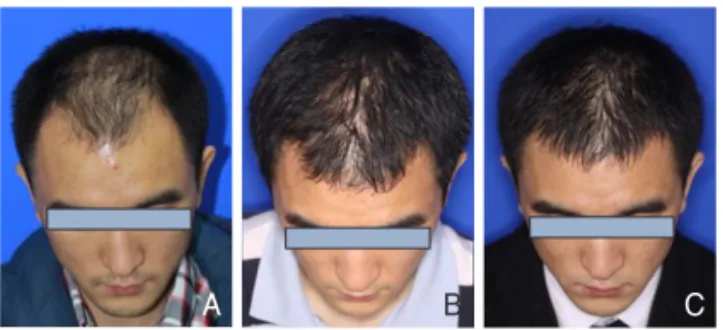 Figure 5.    After 1 year treatment with finasteride. Twenty-six-year- Twenty-six-year-old man showed improvement after combination  ment  with  finasteride  and  minoxidil  (A,  before   treat-ment; B, after 6 months; C, after1 year).
