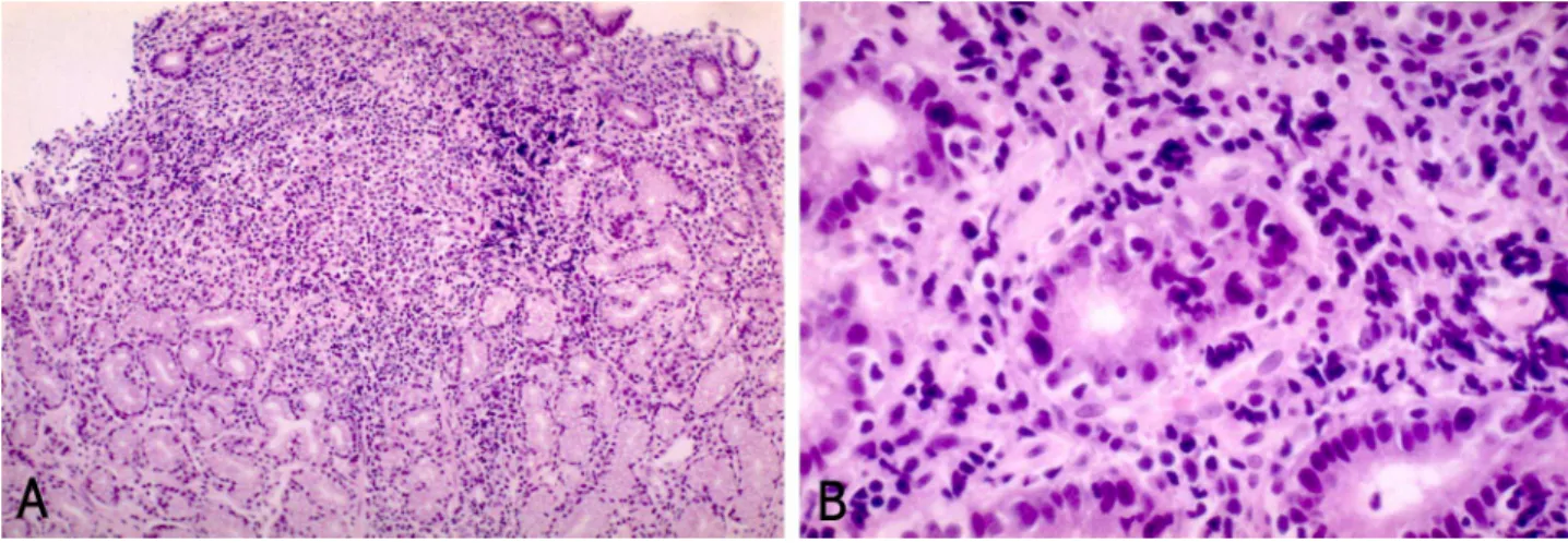 Fig. 3. L26 immunohistochemistry finding of endoscopic biopsy specimen. In L26 immunohistochemistry (which is a staining method specific for CD20, B cell marker), lymphoepithelial lesions are surrounded by infiltrating B-lymphocytes (immunohistochemistry, 