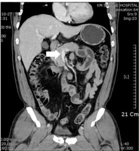 Fig. 2. Abdominal CT findings. Six weeks later, coronal CT  image showed complete dissolution of superior mesenteric vein thrombosis (arrow).증        례45세  남자가  내원  하루  전부터  발생한  지속적인  상복부  통증을  주소로  외래를  통해  입원하였다