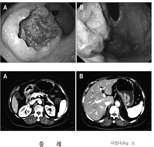 Fig. 1. Gastroscopic findings. (A)  Initial gastroscopic finding showed  huge ulcerative mass on the  anterior wall of antrum