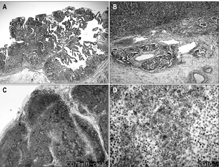 Fig. 3. Microscopic findings and immunohistochemical stain. Histologic finding of gastric antral mass reveals moderately (A) (H&amp;E,