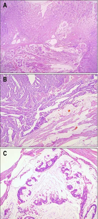 Fig. 4. Microscopic findings. (A) Tumor was located under the inctact mucosa (H&amp;E, ×20)