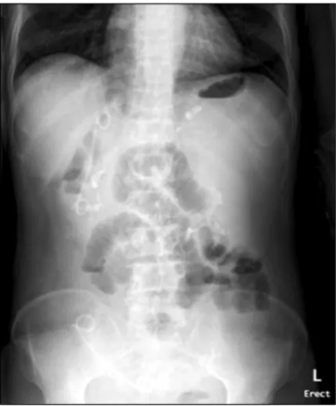 Fig. 2. Computed tomography. CT scan showed a large gallstone with ERBD in the ileocecal valve.