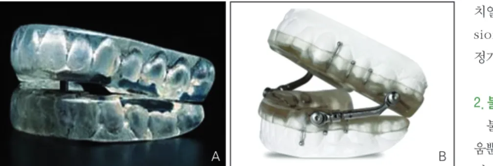 Figure 2.  Mandibular advancement device. (A) Monoblock and (B) two-block.