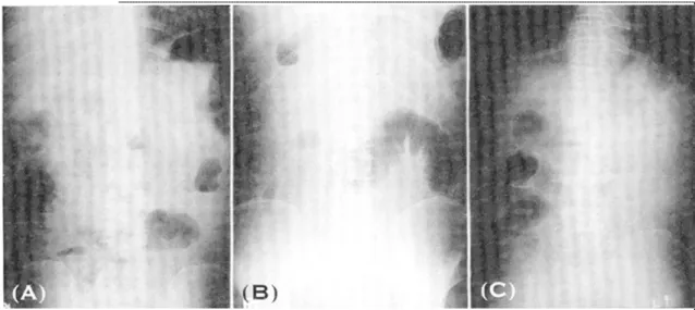 Fig. 1. Simple abdomen erect views in patients with intestinal obstruction. Multiple air-fluid levels in dilated small bowel are observed at the right lower quadrant of abdomen (A)