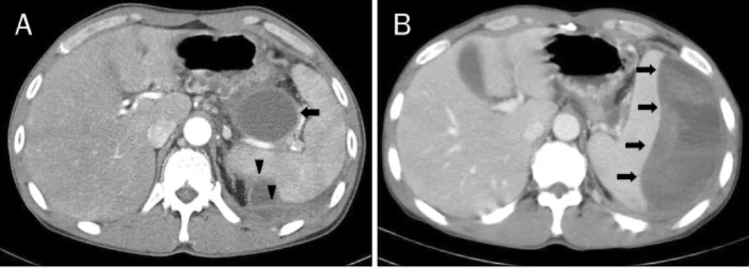 Fig. 1. Computed tomographic (CT) scan images during the second episode of pancreatitis and in the emergency room