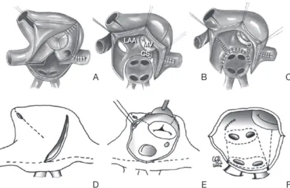 Figure 4.   Diagram of the left atrial (A) and right atrial (B) ablation  procedures using cryoablation (dotted lines)