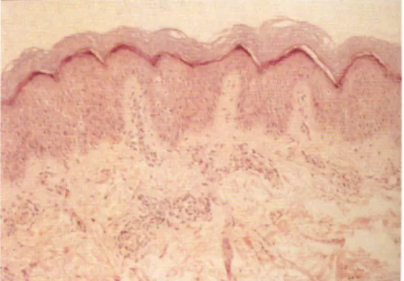 Fig. 1. Close up view of the skin lesion. Multiple ery- ery-thematous papules are apparent on the dorsum of left hand.
