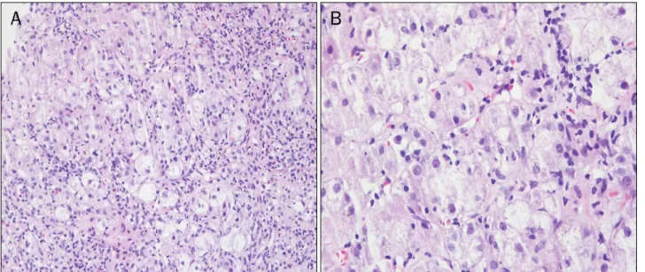 Fig. 1. Pathologic findings of liver biopsy specimen. (A) Interface hepatitis with bridging fibrosis was observed (H&amp;E stain, ×100)