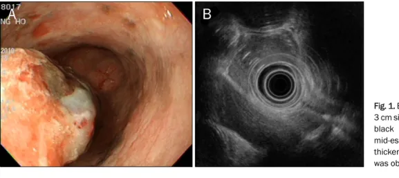 Fig. 1. Endoscopic and EUS finding. (A) 3 cm sized polypoid mass with central  black pigmentation was noted in  mid-esophagus
