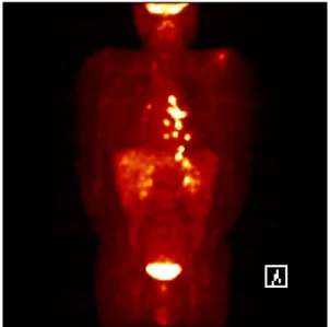 Fig. 3. Whole body PET showed multiple hypermetabolic uptakes in mediastinal lymph nodes, paravertebral area and ribs.