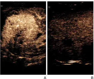 Figure 1.  Contrast-enhanced sonography of hepatocellular carcino- carcino-ma. (A) Arterial phase image obtained 16 seconds after the injection  of contrast material shows increased enhancement of the tumor