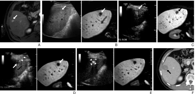 Figure 1.  Radiofrequency ablation with assistance of Sonazoid enhanced ultrasound (US) and fusion image guidance with magnetic reso- reso-nance (MR) imaging