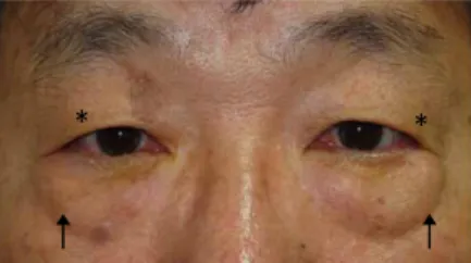 Figure 4.  Photographs of a 57–year-old man showing both upper  lid skin drooping (dermatochalasis, asterisk) and prolapsed fat on  both lower eyelids (festoon, arrow).