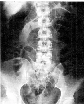 Fig. 1. Simple abdomen x-ray. It shows mild dilatation of small bowel and air-fluid level.