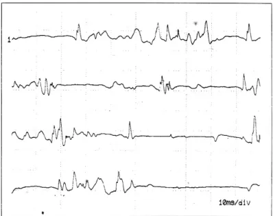 Fig. 2. EMG finding of right brachioradialis. It shows increased insertional activity at rest, grade 1(+) positive sharp wave and fibrillation.