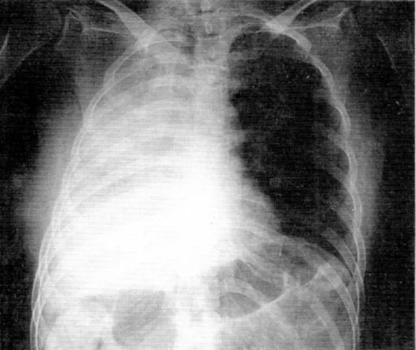 Fig. 4. Chest X-ray finding. It shows aspiration pneu- pneu-monia and right side atelectasis.