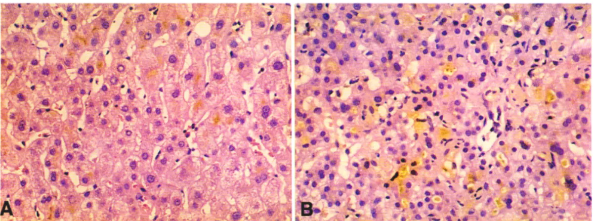 Fig. 1. Microscopic findings of liver biopsy. They show cholestatic pattern in one patinet (A) and marked cholestasis and disarrayed architecture of liver lobule in the other patient (B)