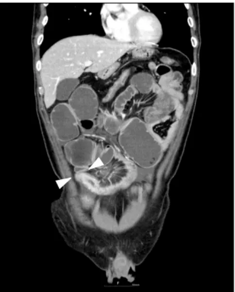 Fig. 2. Small bowel series. It  showed segmental luminal narrowing  and stricture with ulceronodular mucosa (arrow heads).