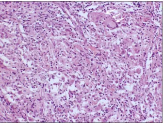 Fig. 4. Microscopic findings of peritoneum. Multinucleated giant cell (arrows) and chronic granulomas with epithelioid cells, consistent  with tuberculous peritonitis, were noted (H&amp;E, ×100).