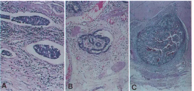 Fig. 1. Histologic section of floating type (A), filling type (B) and occlusive type (C) of vascular invasion