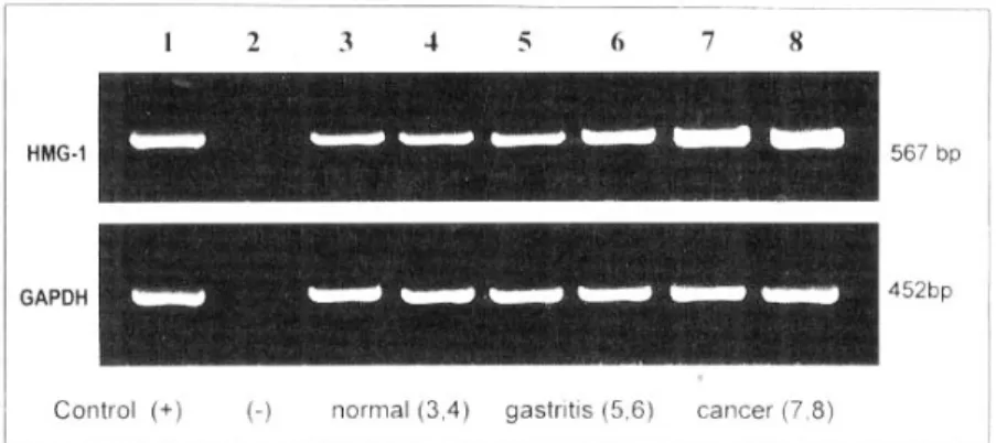 Fig. 2. Comparison of HMG-1/GAPDH ratio in normal, gastritis, and gastric cancer patients