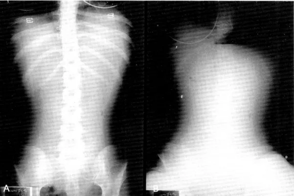 Fig. 2. An abdominal computed tomography on admis- admis-sion. Markedly dilated stomach and duodenum are noted.