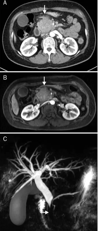 Fig. 1. Abdominal CT and MRI/MRCP findings. (A) Abdominal CT  showed bulging contour, mass-like lesion in the head of the pancreas (arrow)