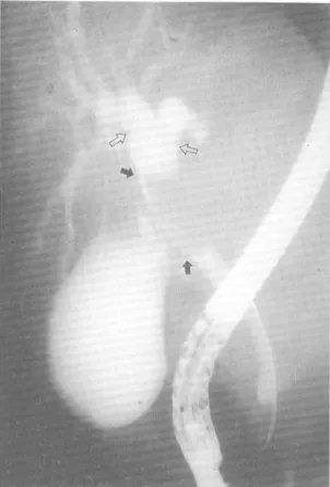 Fig. 2. Abdominal CT scan. Heterogeneously enhanced mass with poorly defined margin in the left lobe of liver showed focal contour bulging (arrows)