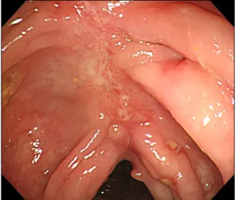 Fig. 3. Colonoscopic finding of the transverse colon. It showed  longitudinally arrayed, linear, active ulcers with several inflammatory pseudopolyps and normal looking background mucosa.