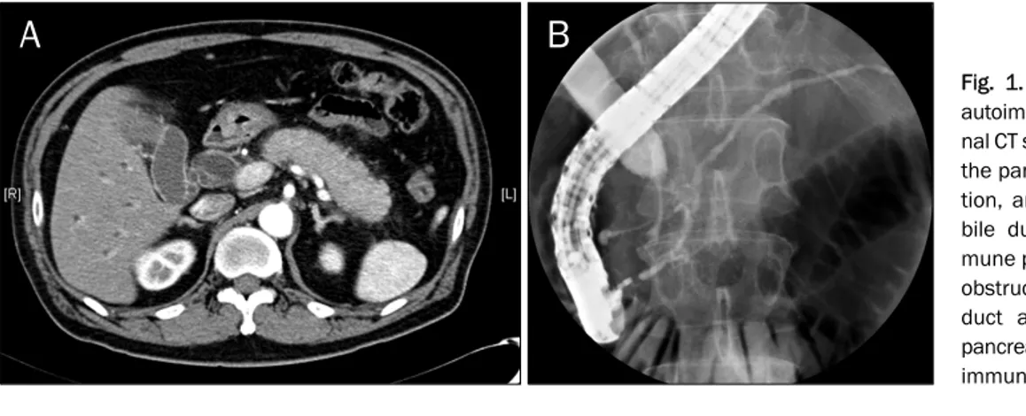 Fig. 1. Abdominal CT and ERCP of  autoimmune pancreatitis. (A)  Abdomi-nal CT showed diffuse enlargement of the pancreas, peripancreatic  infiltra-tion, and dilatation of the common  bile duct, compatible with  autoim-mune pancreatitis