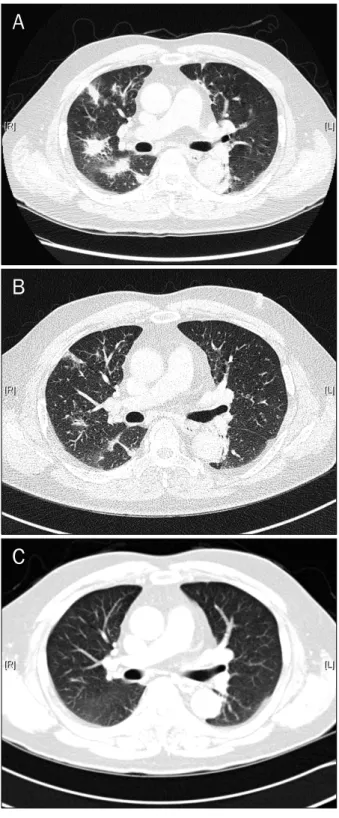 Fig. 2. Chest CT of pulmonary involvement of autoimmune  pancreatitis. (A) Chest CT showed multifocal consolidation with  fibrosis and emphysematous change at both lungs