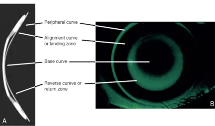Figure 1.   (A) Cross-section of reverse geometry lens. (B) Fluorescein pattern of reverse geo- geo-metry lens