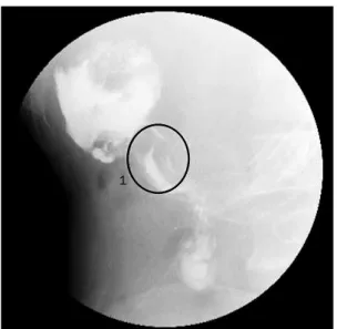 Fig. 4. One month after the last TACE, upper gastrointestinal series  revealed extraluminal contrast leakage suggesting  hepaticoduo-denal fistula.