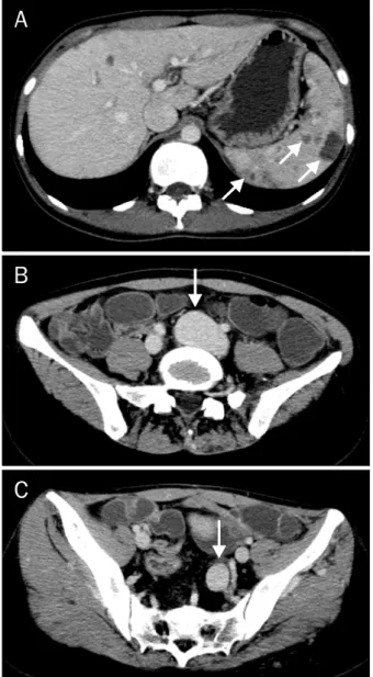 Fig. 1. An abdominal CT scan revealed multiple hemangiomas in the  spleen (A), and fusiform aneurysmal dilatation of the left common (B) and internal iliac veins (C)