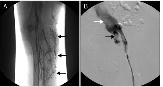 Fig. 3.  Venography  of  the  left  leg  revealed dilated superficial veins in  the subcutaneous tissues (A) and  aneurysmal dilatation of the left  common (white arrow) and internal  iliac veins (black arrow) (B).