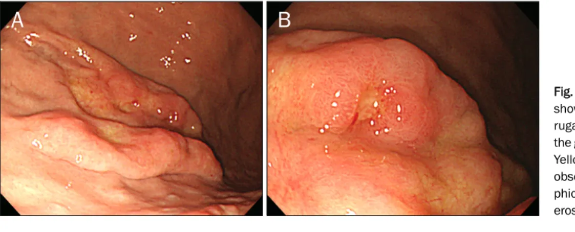 Fig. 1. Endoscopic findings. (A) It  showed prominent and thickened  rugal folds with hard consistency in  the greater curvature of the mid-body.