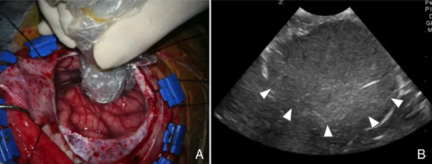 Figure 3.   The use of intraoperative ultrasonography for real-time identification of brain paren- paren-chymal lesions
