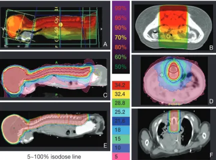 Figure 4.   An example of proton beam treatment plan, irradiating only thecal sac. As most of  the vertebral bones are excluded from the radiation field, bone marrow function can  be preserved