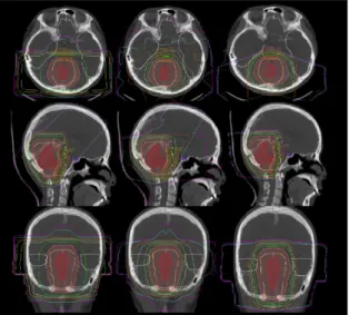 Figure 5B.   Comparison  of  dose  volume  histogram  obtained  from  intensity-modulated  radiation  therapy  (IMRT,  triangle  symbol)  and  proton  beam  therapy  (square  symbol)