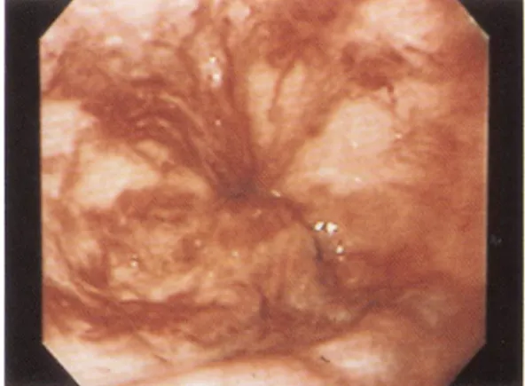 Fig. 1. Endoscopic finding. Bead-like varices with red- red-color sign are noted at lower esophagus.