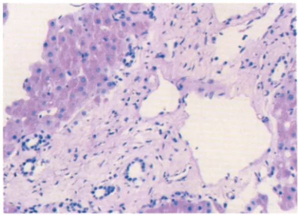 Fig. 5. The liver biopsy finding. There are many bile ductules along the margin of fibrous band